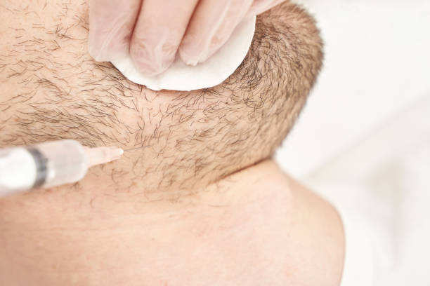 Hair transplant procedure close-up