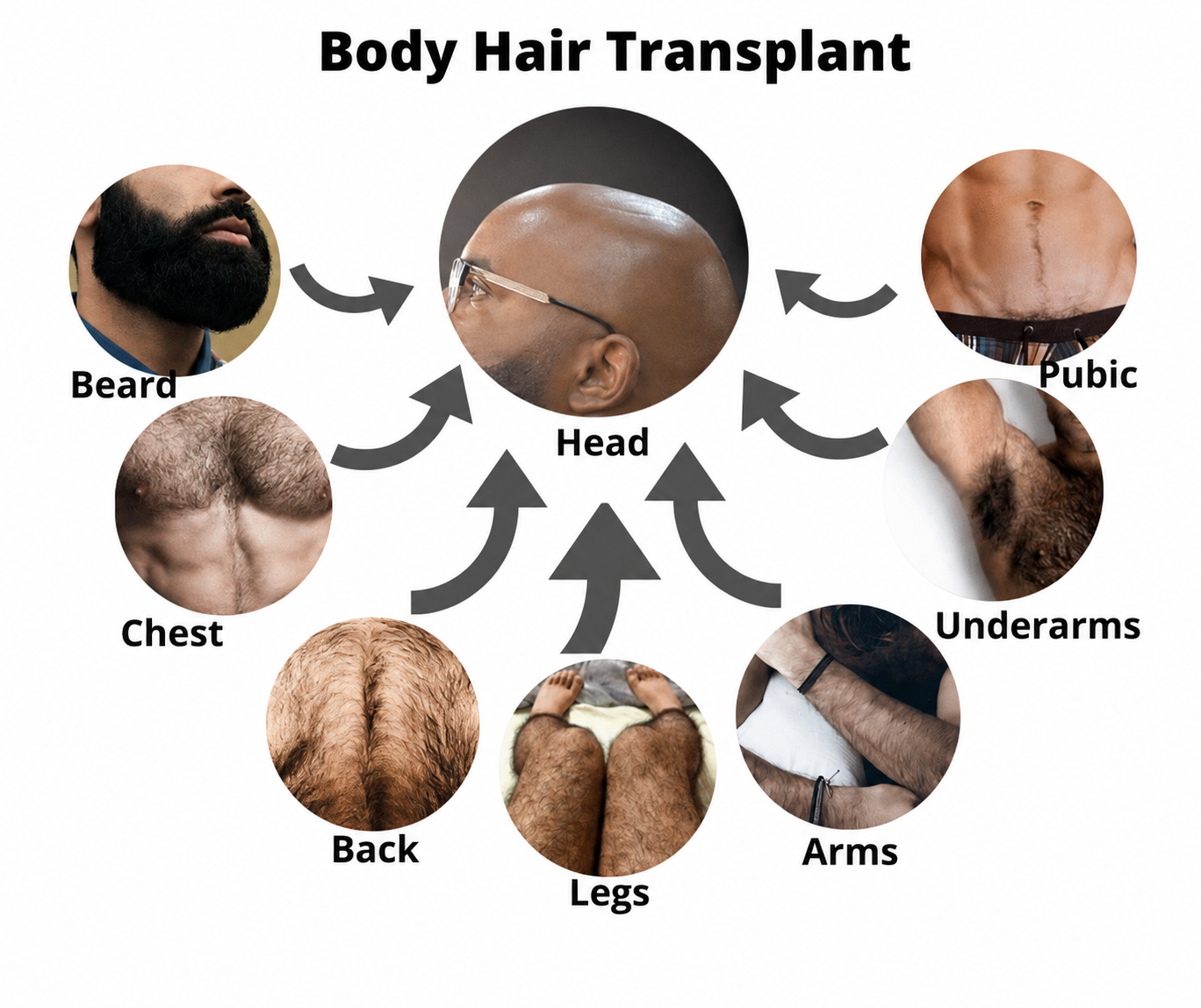 Body hair transplant procedure close-up