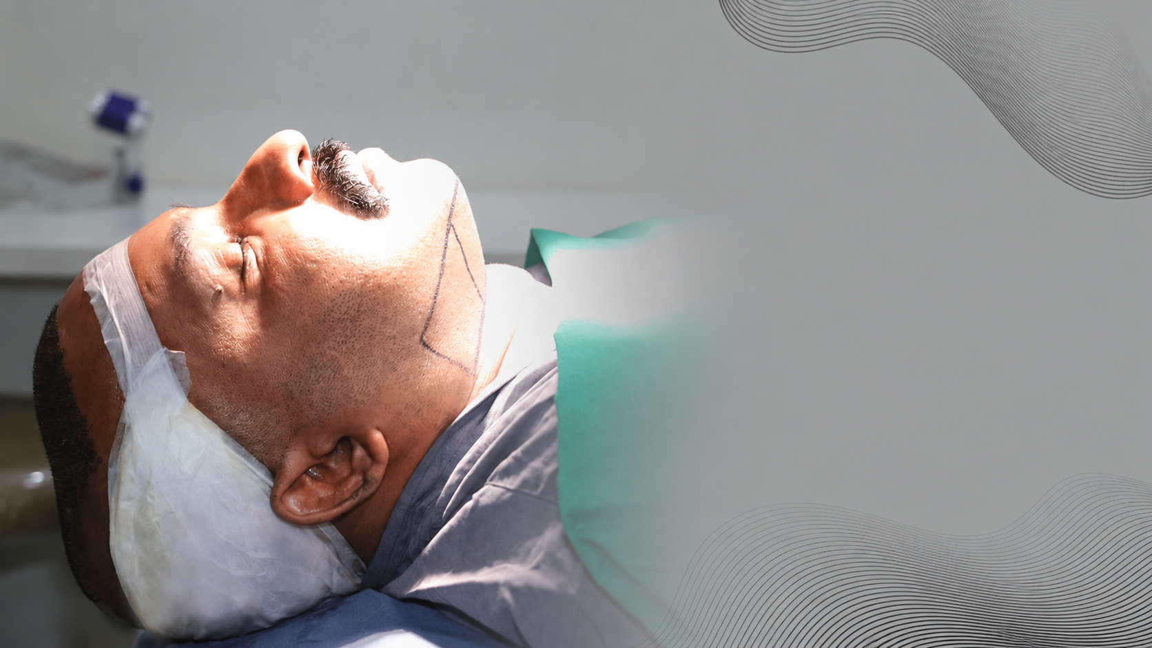 Body Hair Transplant