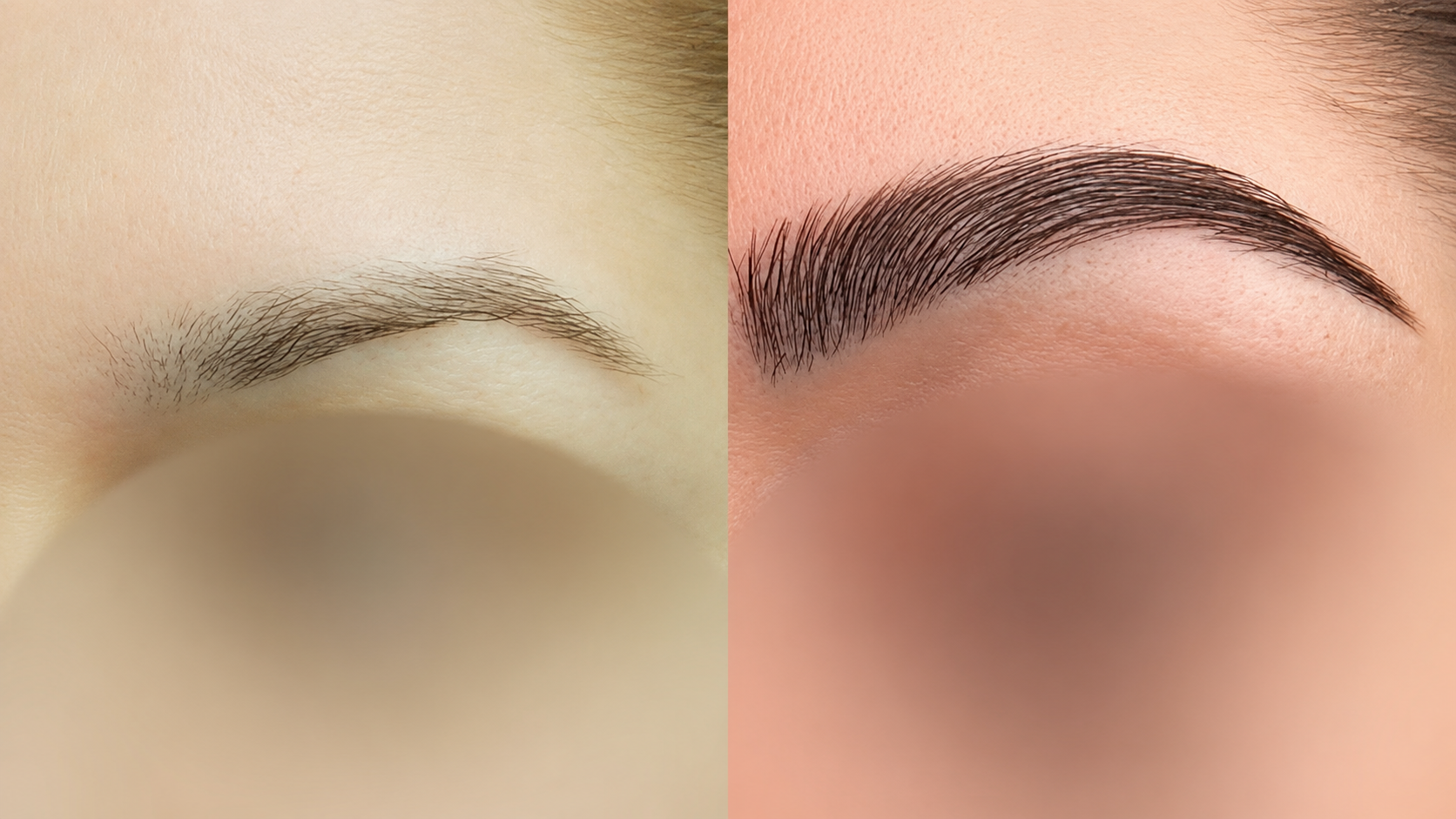 Eyebrow Hair Transplant