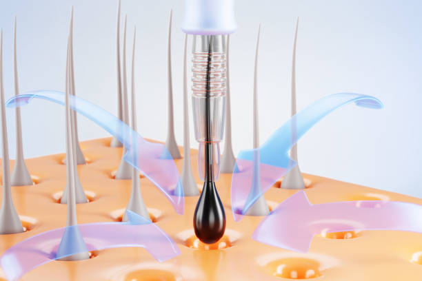 FUT donor strip harvesting and follicle transplantation