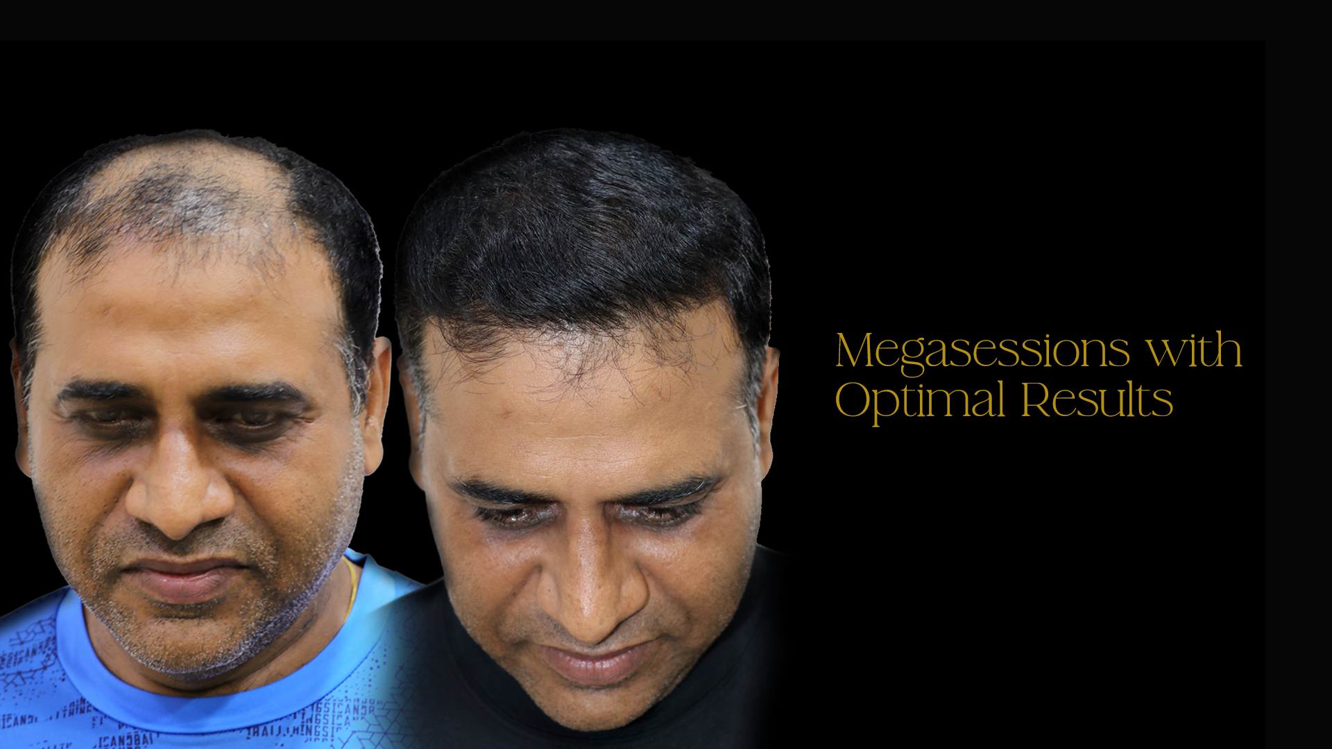 Hair Transplant Cost in Pune 2