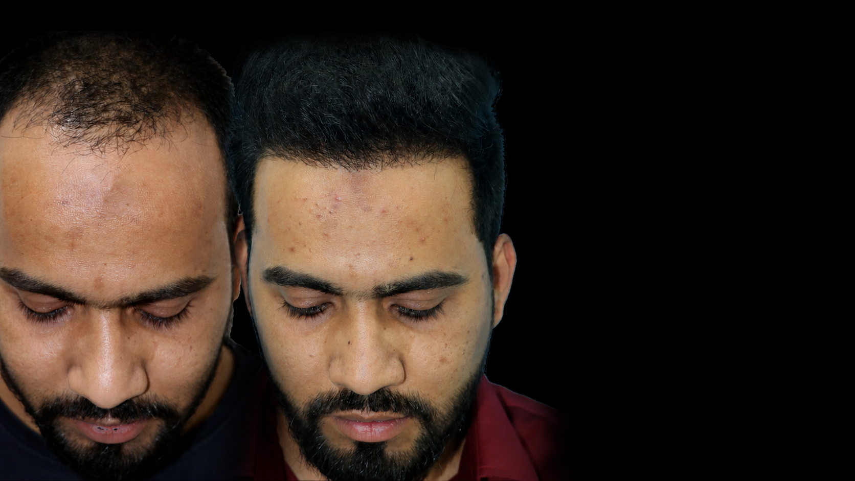 Hair Transplant Surgery in Pune