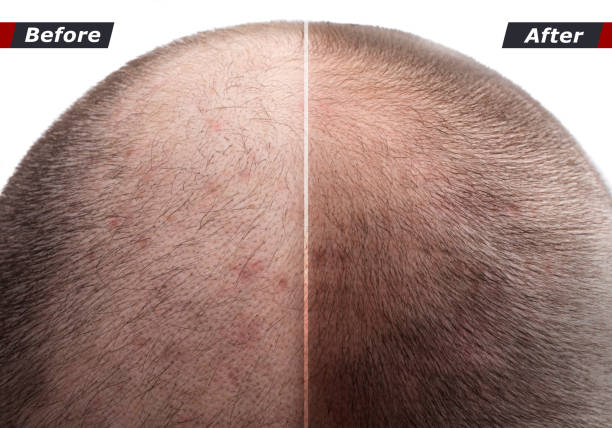Hair regrowth result after laser therapy