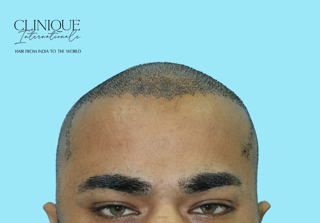 Hair transplant procedure close-up