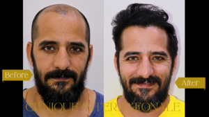 Hair Transplant Before After