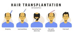 Hair Transplant cost