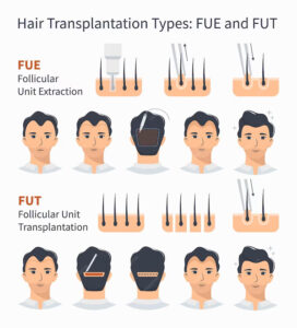 FUE and FUT Hair Transplant