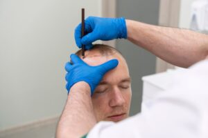 Hair Restoration 