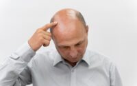 male pattern hair loss