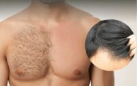 Body Hair Transplant