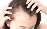 Female Hair Loss Treatment