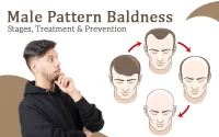 male pattern baldness treatment