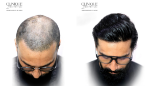 Best Hair Transplant in Mumbai