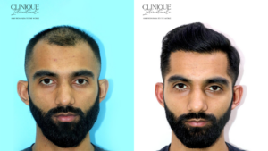 Best Hair Transplant in Mumbai