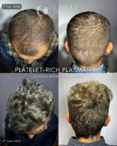 Hair PRP Treatment in Pune