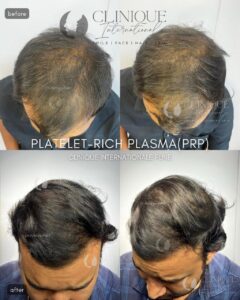 Hair PRP Treatment in Pune