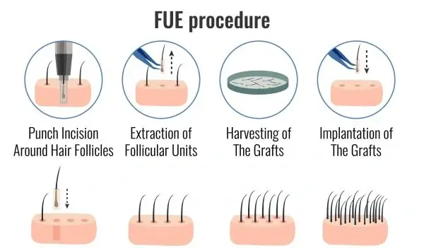 FUE (Follicular Unit Extraction)