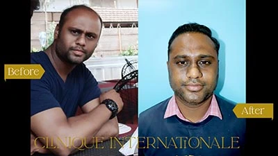 Hair Transplant Bangalore after before