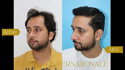 Hair Transplant Bangalore after before