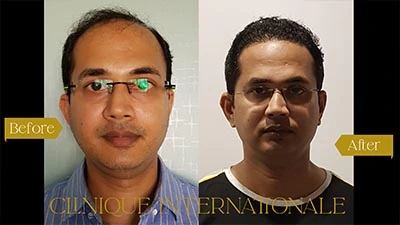 Hair Transplant Bangalore after before