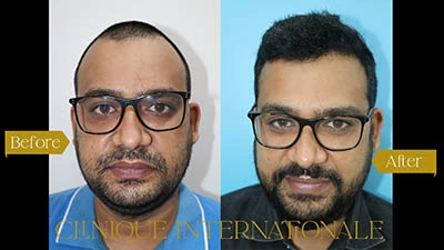 Hair Transplant Bangalore after before